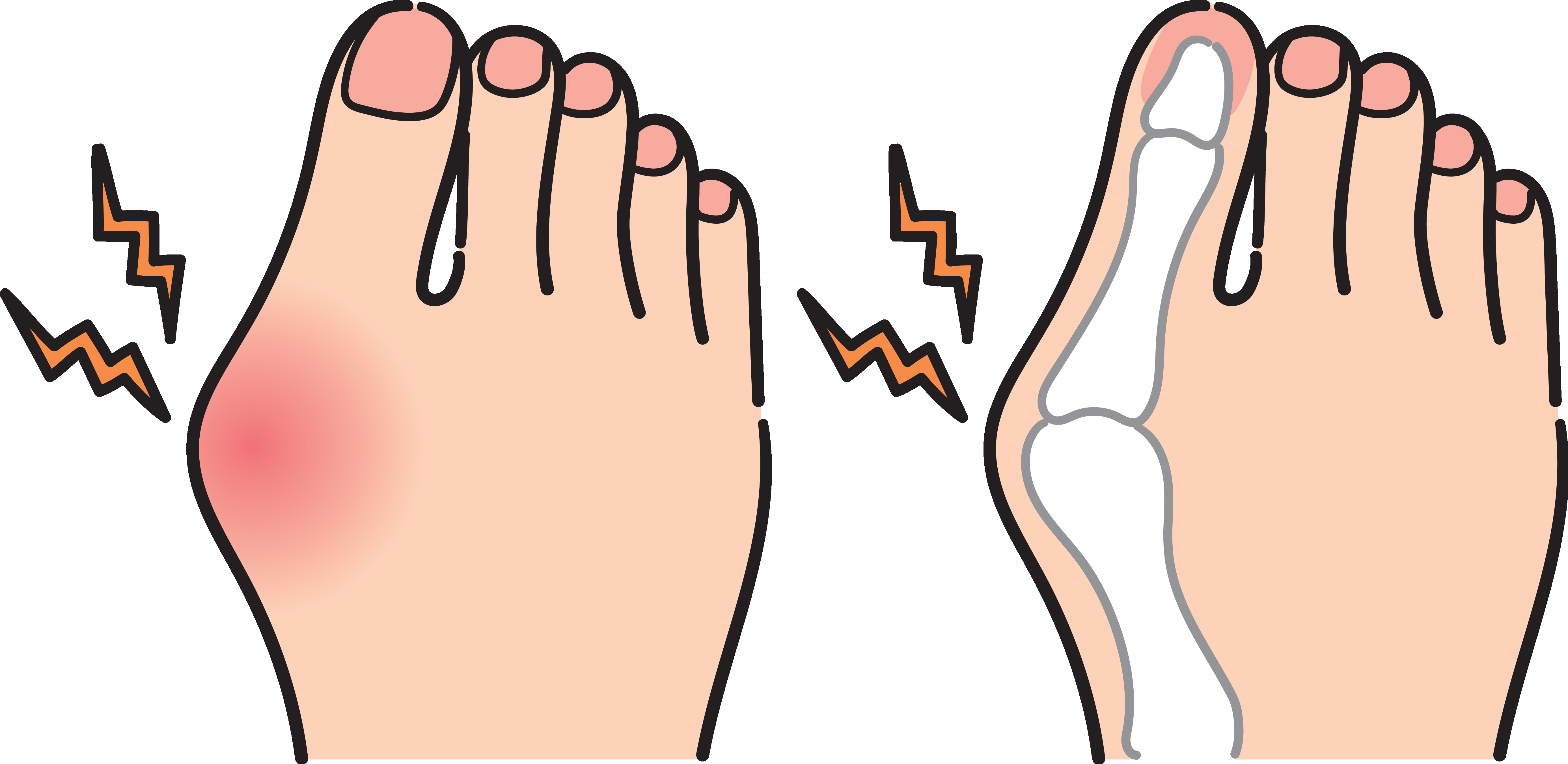 Sandalias recomendada para pies con Hallux Valgus "Juanetes"
